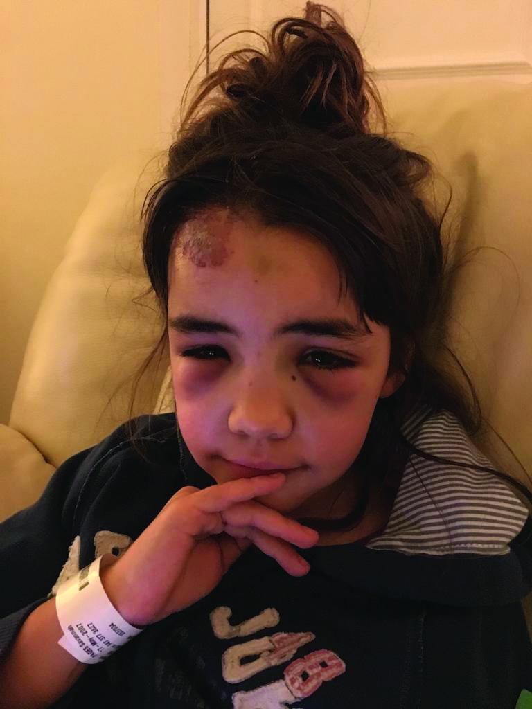 Savannah at home after her accident